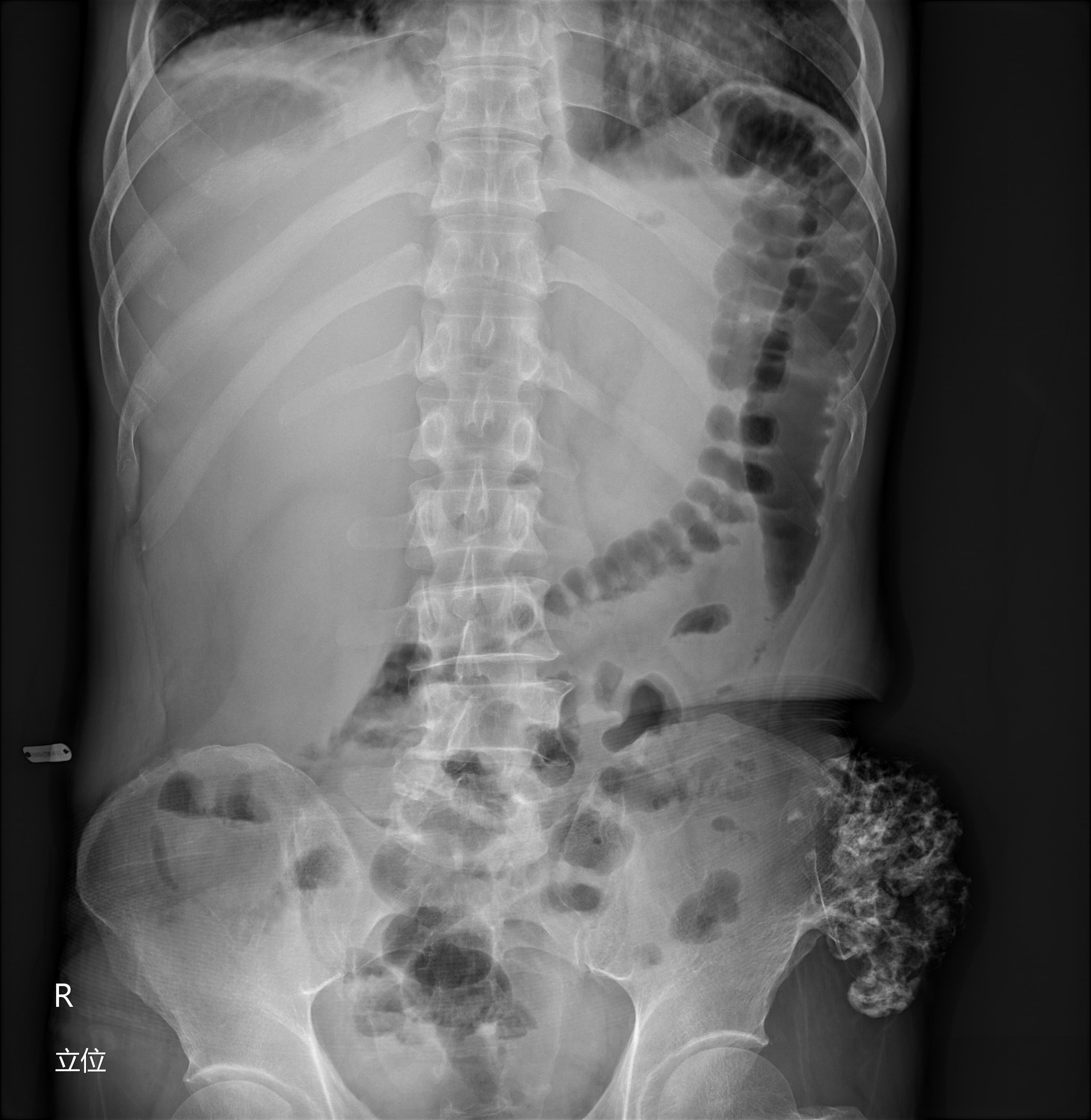 Bone Tumour Classification